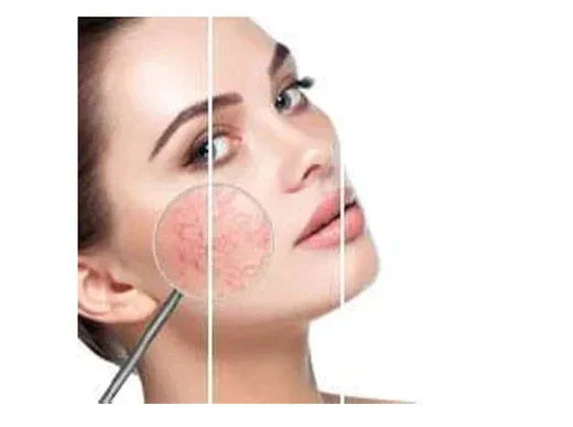 Як вибрати домашній догляд при куперозі від бренду Holy Land?